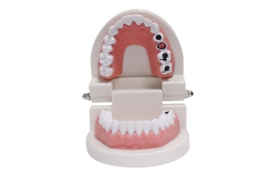 蛀牙模型