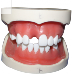 種植牙模型（含上、下頜）